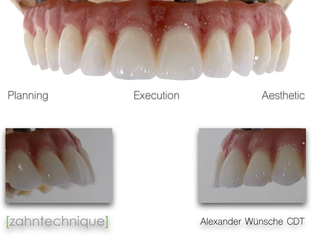 Zirconia Hybrid Restorations Techniques for Planning, Design and